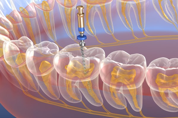 Dental Implantation