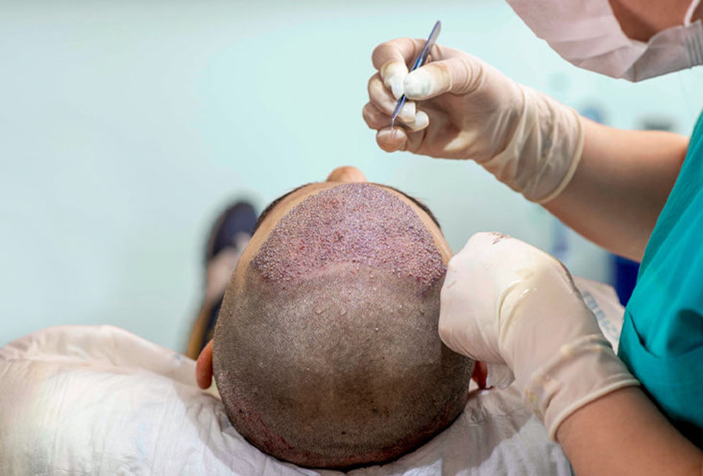 hair_transplant